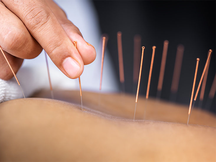 acupuncture therapy in DLF Phase 1 gurgaon