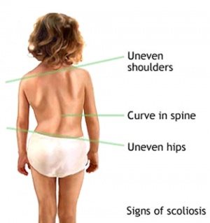 scoliosis treatment in gurgaon